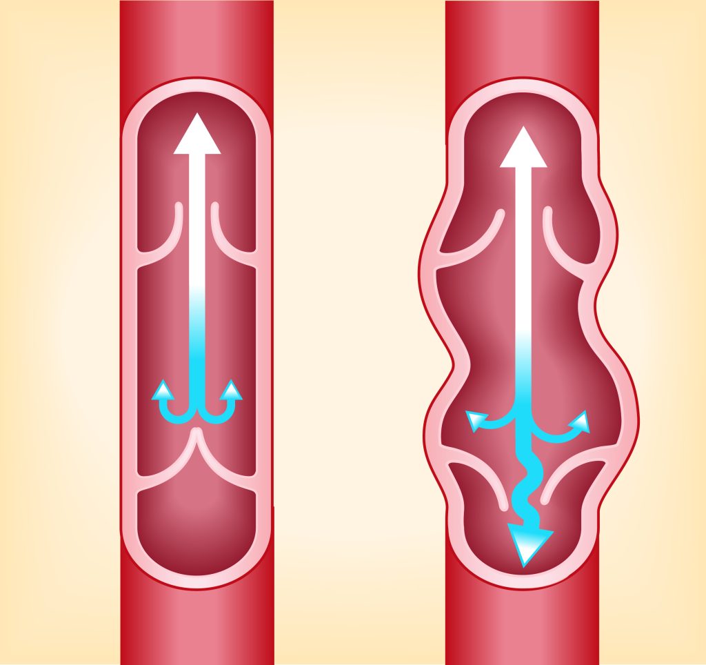 Rimedi per le vene varicose